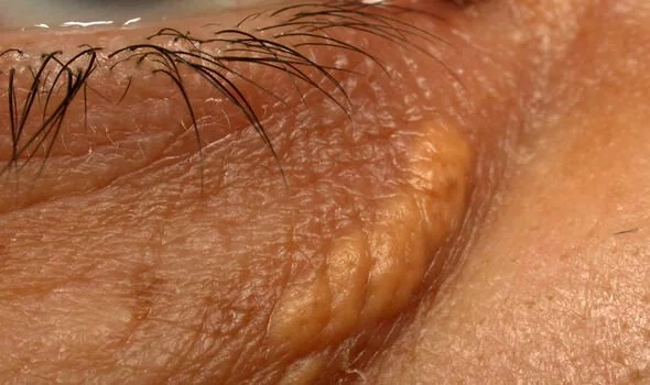 Benjolah Kuning di sekitar mata